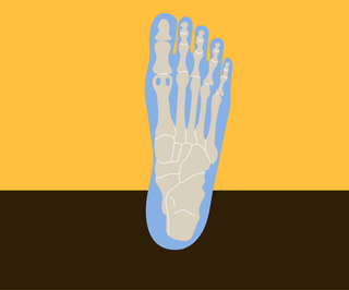 What is Morton’s Neuroma?