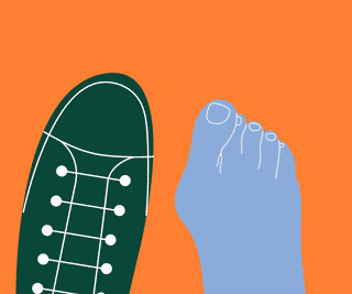 Foot with bunion next to shoe